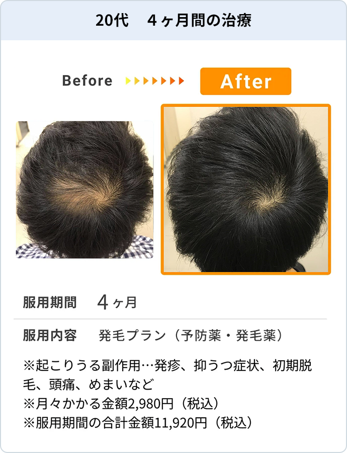 20代 4ヶ月間の治療