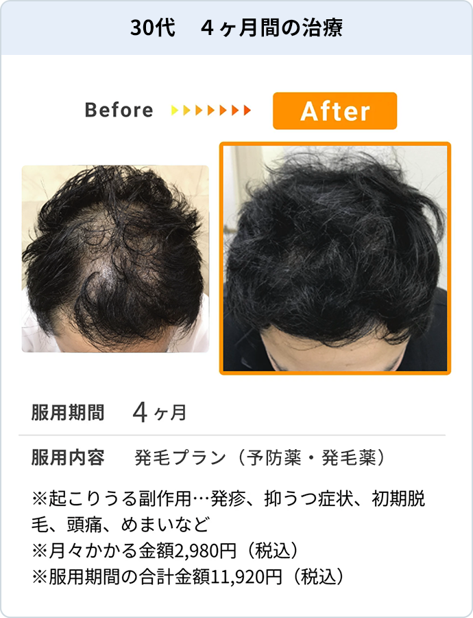 30代 4ヶ月間の治療